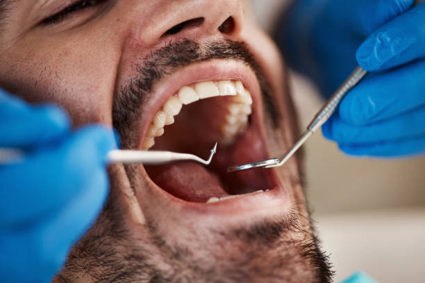 Best Root Canal Emergency Dentist  in Benton, LA