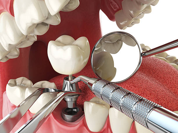 Best Urgent Tooth Repair  in Benton, LA